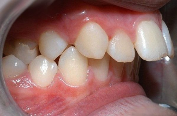 răng hô là gì