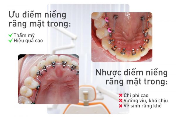 ưu nhược điểm của niềng răng mặt lưỡi