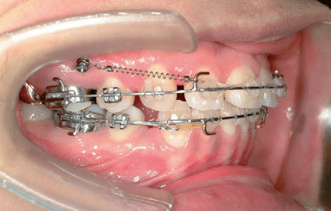 giai đoạn đóng khoảng răng
