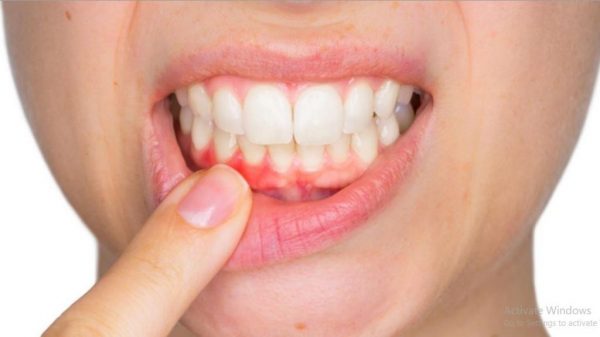 nguyên nhân gây bệnh viêm nướu là gì, nguyên nhân viêm nướu là gì, viêm nướu là gì, viêm nướu răng là gì, bệnh viêm nướu là gì, viêm lợi là bệnh gì, viêm nướu răng là gì