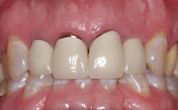 Nha khoa sử dụng răng kém chất lượng và bị hở ở chân răng