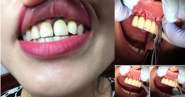 Răng bị tụt lợi sau khi bọc răng sứ tại nha khoa kém chất lượng